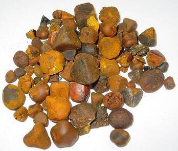 GALLSTONES gallstones are used in alternative medicine to treat hepatitis and other liver and gall bladder-related ailments
